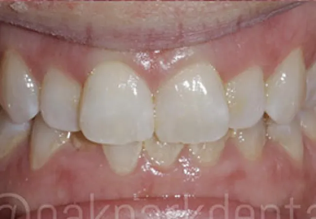 Close-up of misaligned lower and upper front teeth with visible gum tissue, showing dental crowding and spacing.