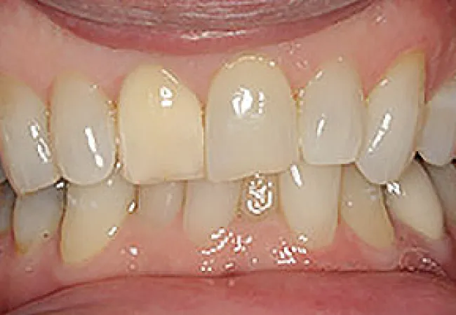 Close-up of upper and lower teeth with dental crowns and natural teeth showing discoloration and alignment.