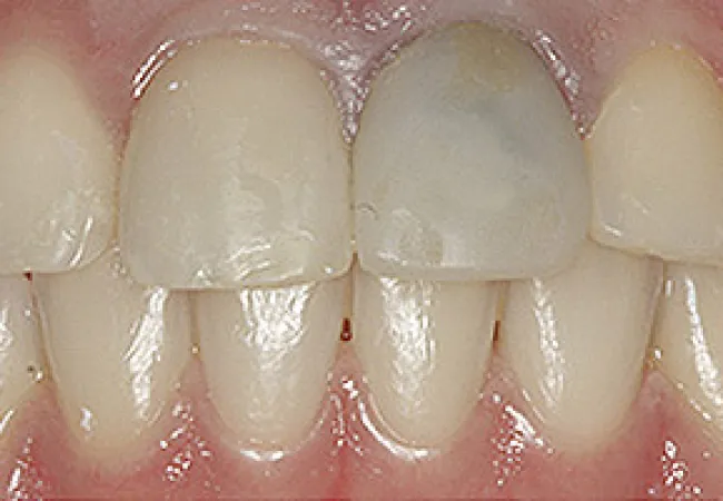 Close-up of healthy natural teeth and gums showing white incisors and canine teeth with smooth surfaces.