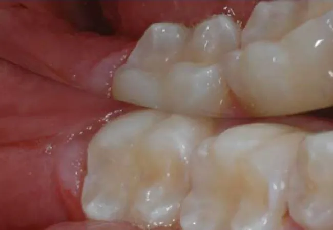 Close-up of healthy human molars with detailed surface texture and gums visible in the mouth