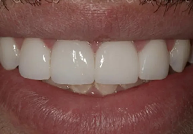 Close-up of a smile showing white upper front teeth and natural lips.