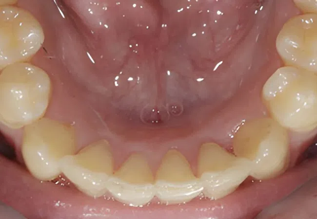 Close-up view of lower teeth and gums showing mild crowding and healthy oral tissue.