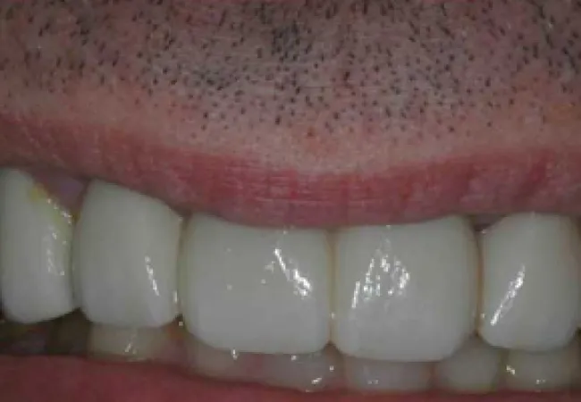 Close-up of a mouth showing white, artificial teeth and natural gums in dim lighting.