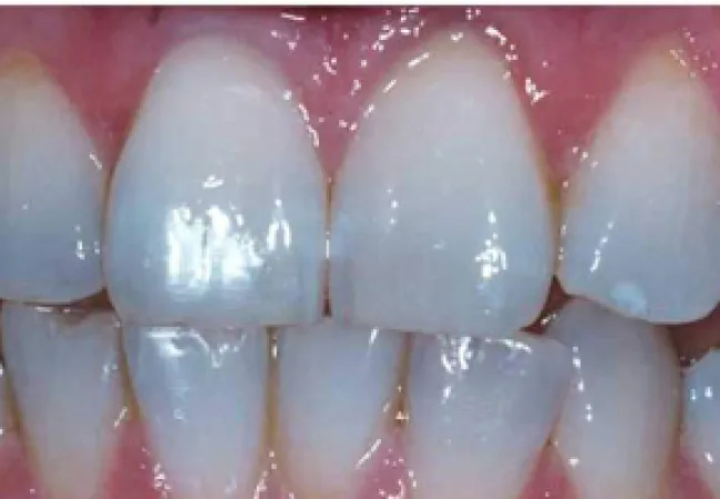 Close-up of clean, healthy human teeth and gums with natural shine and slight gaps between incisors.