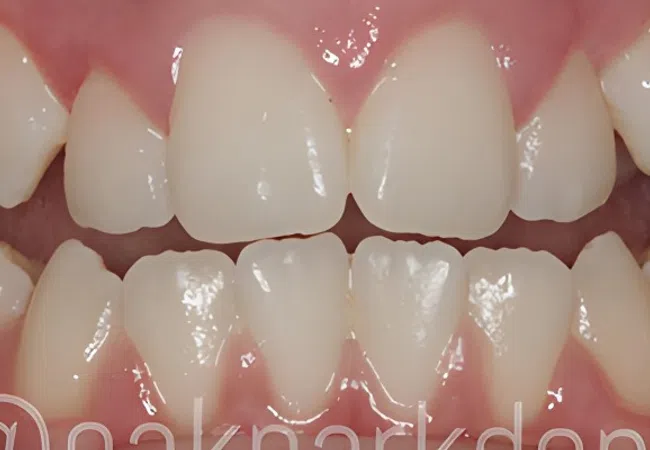 Close-up of healthy upper and lower human teeth with pink gums and natural enamel shine.