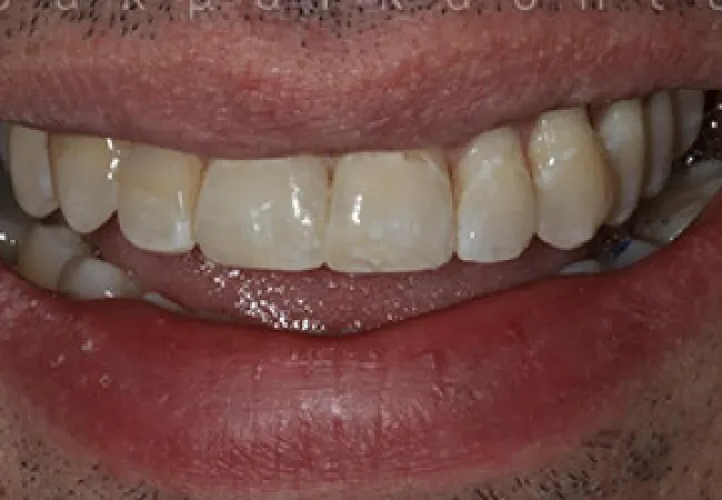 Close-up of a smiling mouth showing upper teeth with slight discoloration and natural texture on lips.