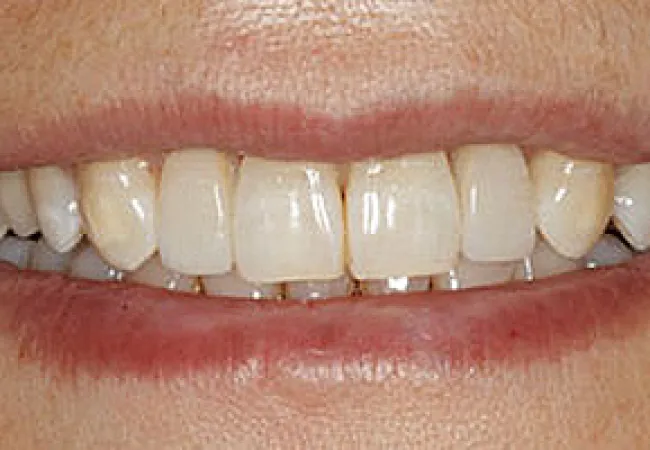 Close-up of a person's smile showing slightly yellowed teeth with a natural lip and skin tone.