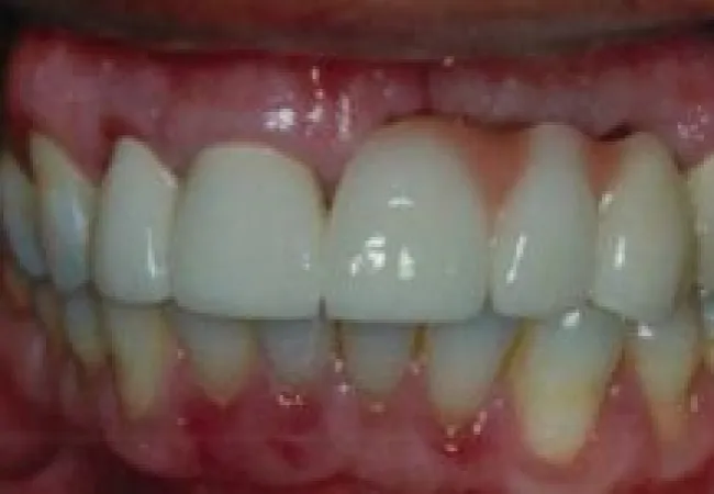 Close-up of teeth showing healthy upper teeth and mildly inflamed gums with plaque buildup on lower teeth.