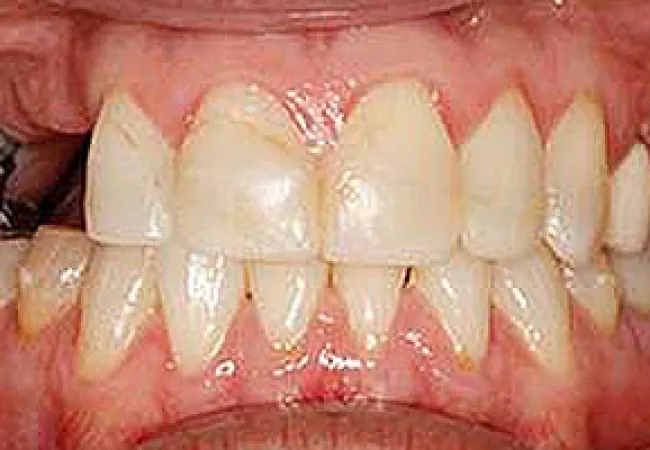Close-up of human teeth showing dental metal filling and gum inflammation around lower teeth.