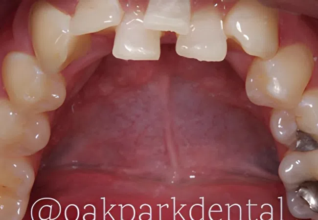 Close-up of upper teeth showing dental fillings and healthy gums in an open mouth.