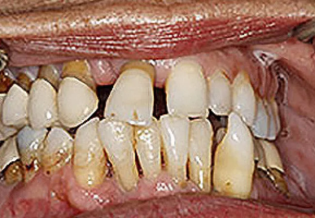Close-up of severely decayed and misaligned human teeth with stains and gum disease visible.