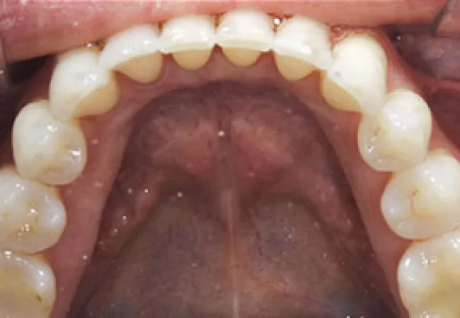 Close-up view of upper teeth and palate showing natural teeth alignment and dental arch structure.