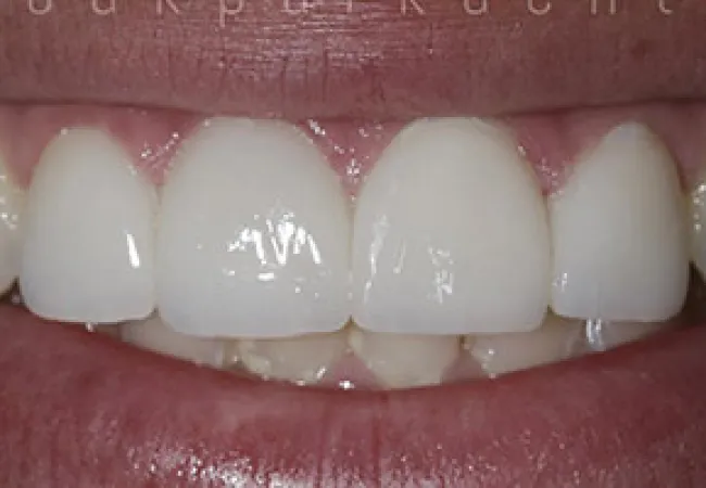 Close-up of a smiling mouth showing white, healthy upper front teeth and pink gums.