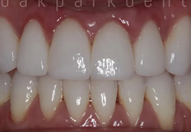 Close-up of clean, well-aligned human teeth with healthy gums and natural shine under bright light.