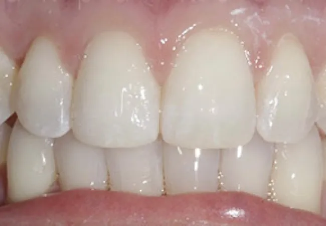 Close-up of white, healthy human teeth and gums with natural alignment and shine under bright light.