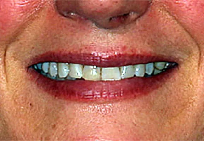Close-up of a smiling mouth showing yellowed and stained upper teeth with uneven edges.