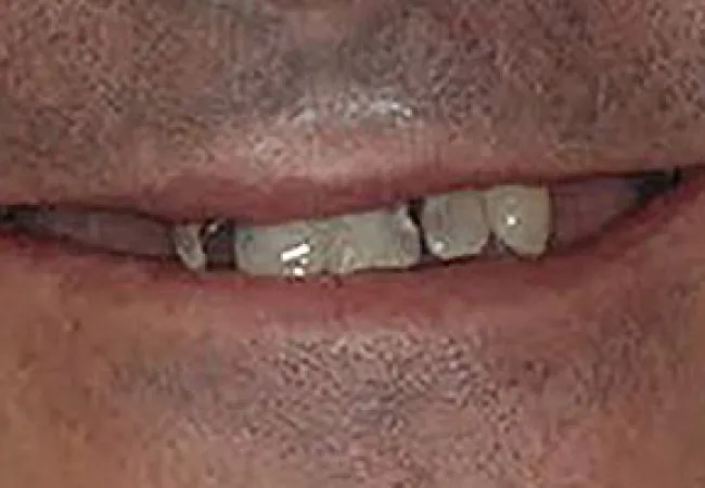 Close-up of a person's mouth showing missing and damaged teeth with uneven gum line.