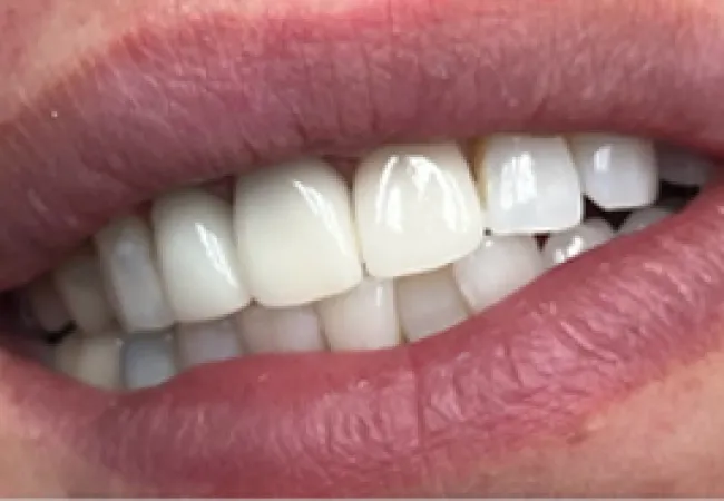 Close-up of a smiling mouth showing white, even teeth and natural pink lips.