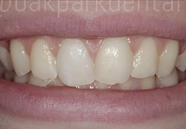 Close-up of healthy upper and lower teeth with slight overlap and natural color in a smiling mouth.
