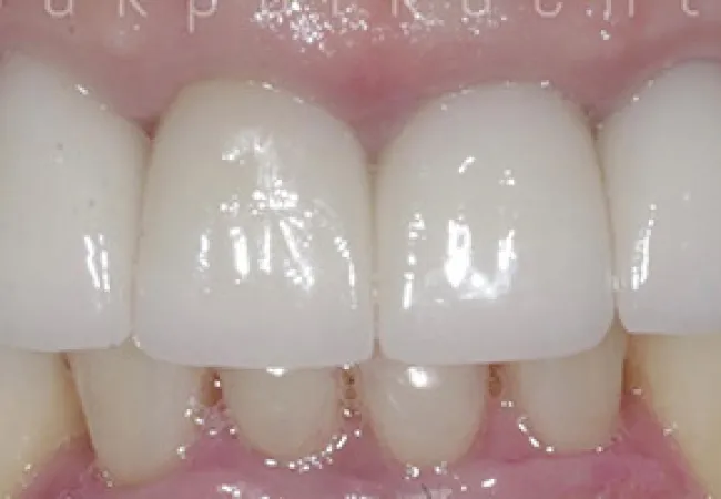 Close-up of upper front teeth showing dental crowns or veneers with healthy gums and natural teeth.