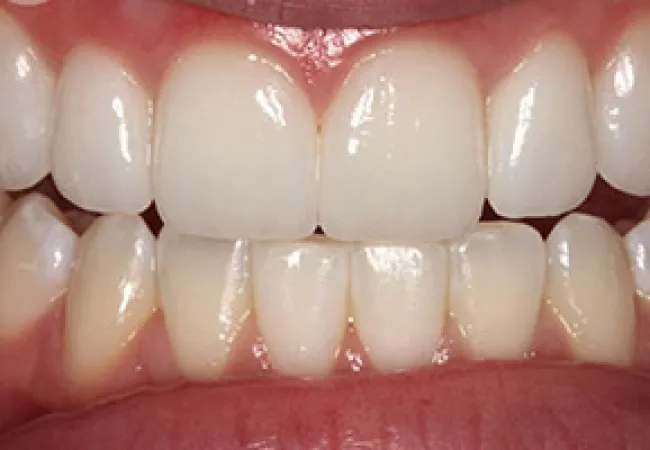 Close-up of healthy human teeth and gums showing clean, white teeth and natural pink gums