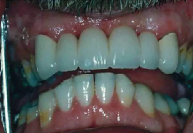 Close-up of a person's mouth showing teeth with dental crowns and plaque buildup on natural teeth.