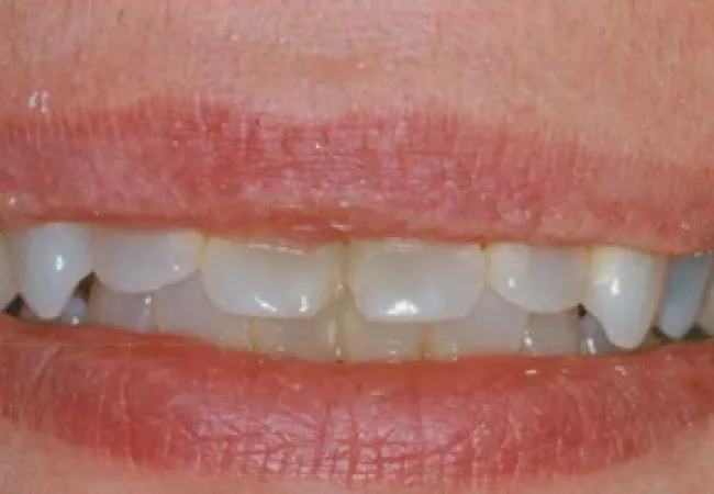 Close-up of a person's smile showing slightly misaligned white teeth and natural lips.