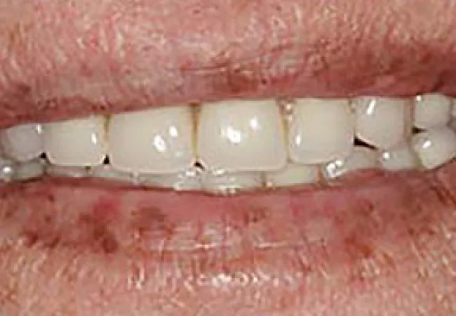 Close-up of smiling lips showing white teeth and aged skin with visible wrinkles and spots.