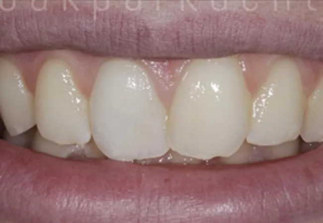 Close-up of a smile showing slightly misaligned upper front teeth and natural lips.