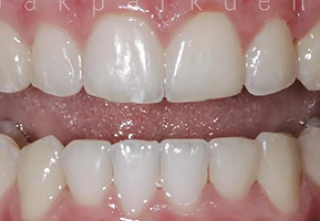 Close-up of healthy, clean human teeth and gums showing natural dental alignment and color.