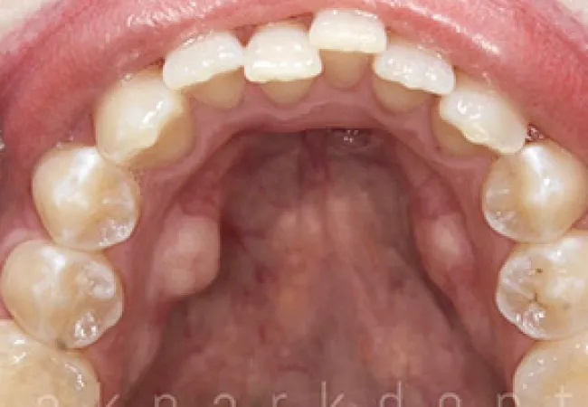 Close-up view of upper teeth and palate showing natural tooth alignment and surface details.