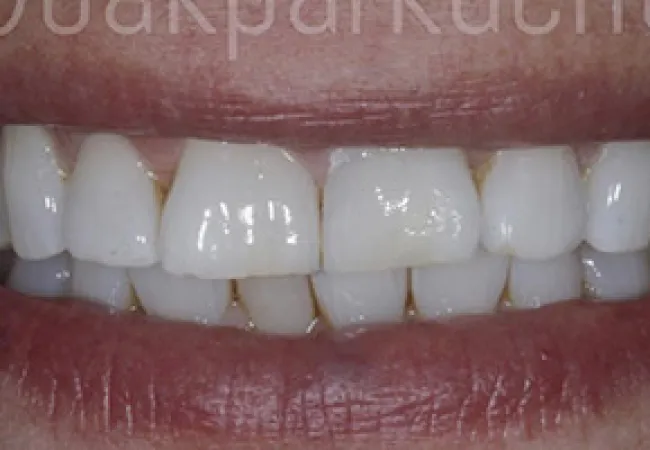 Close-up of a bright smile showing clean, white, evenly spaced teeth with natural lips.