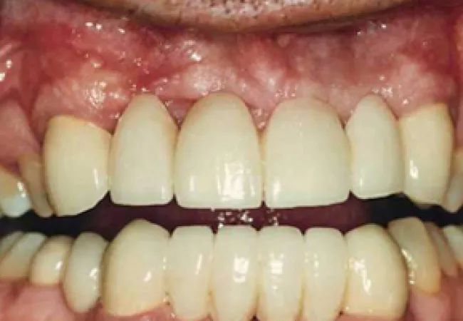 Close-up of human teeth with noticeable gaps and uneven alignment in upper and lower jaws.