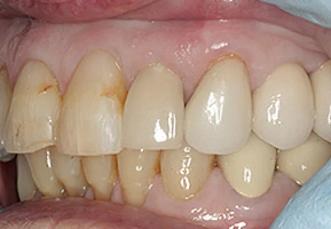 Close-up of stained and worn human teeth with visible plaque and gum tissue, held open by dental gloves.