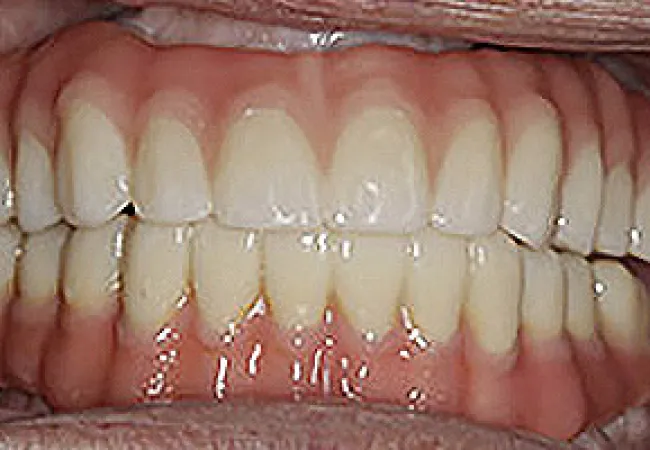 Close-up of a healthy set of natural teeth and gums with no visible dental issues.
