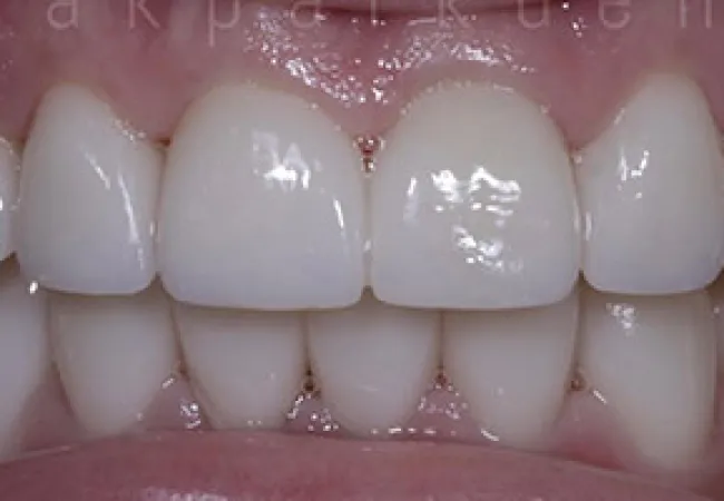 Close-up of clean, healthy upper and lower teeth with smooth gums and a white, even smile.