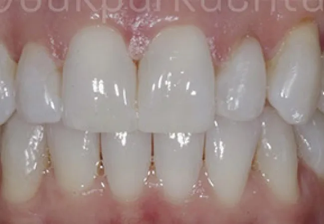 Close-up of healthy, clean human teeth showing upper and lower front teeth with pink gums.