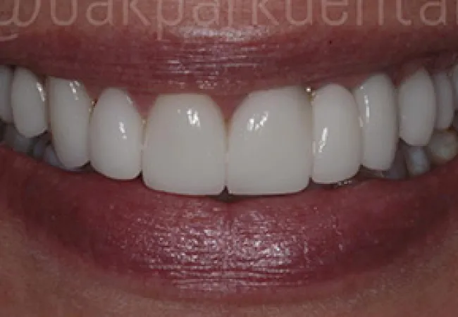Close-up of a bright white smile with healthy teeth and natural lips, showcasing dental care.