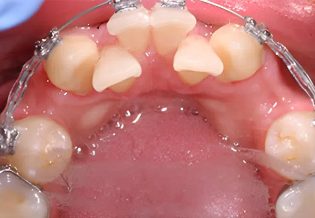 Close-up view of upper teeth with metal braces and wire orthodontic treatment inside mouth.