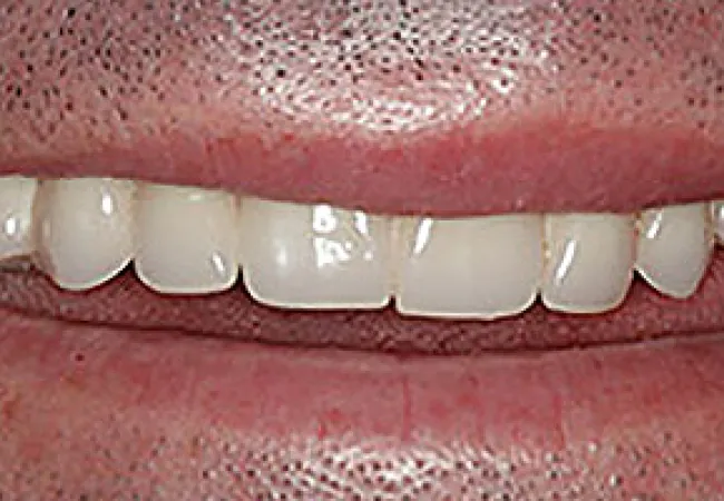 Close-up of a person's mouth showing upper teeth with dental crowns and natural gums.