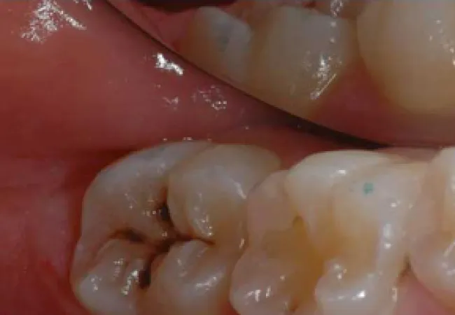 Close-up of molar teeth showing dental cavities and healthy enamel in the lower jaw.