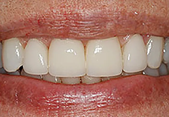 Close-up of a smiling mouth showing white upper dental crowns with natural lips and skin texture.