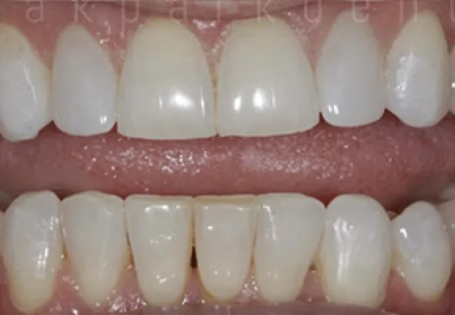 Close-up of a person's mouth showing upper and lower teeth with a slight gap between the central incisors.