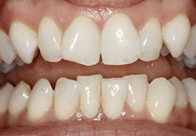 Close-up of teeth showing slight crowding and discoloration on lower front teeth and healthy gums.
