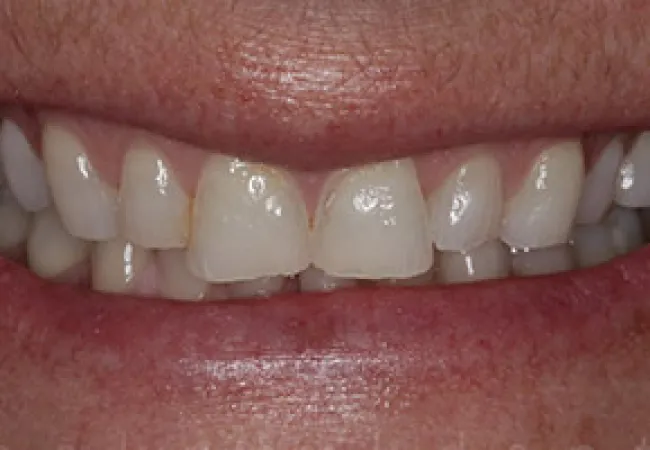 Close-up of a person's mouth showing slightly spaced upper front teeth with natural texture.