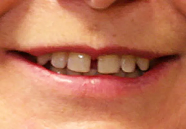 Close-up of a smiling mouth showing natural teeth with slight gaps and healthy lips.