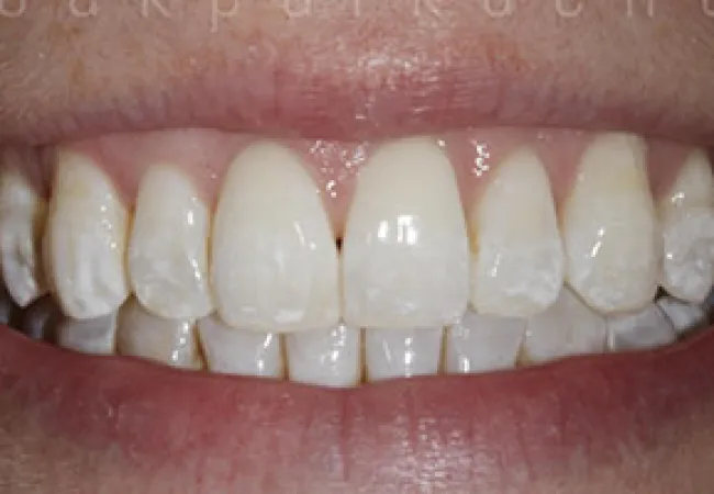 Close-up of a smiling mouth showing teeth with white spot discoloration and healthy pink gums