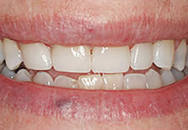 Close-up of a person's smile showing slightly uneven, stained teeth and visible lips.