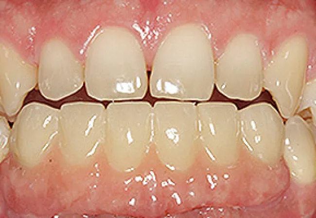 Close-up of human teeth with visible gaps and slight misalignment between upper and lower front teeth.