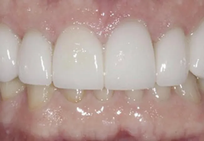 Close-up of a smile showing upper teeth with dental veneers over natural lower teeth.